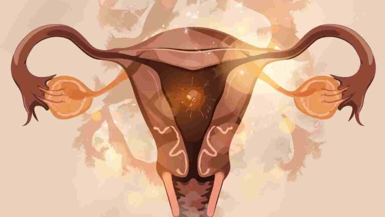 Çikolata Kisti Nedir Belirtileri Nelerdir Çikolata Kisti Hamileliğe Engel Mi Ameliyat Şart Mı