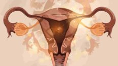 Çikolata Kisti Nedir Belirtileri Nelerdir Çikolata Kisti Hamileliğe Engel Mi Ameliyat Şart Mı