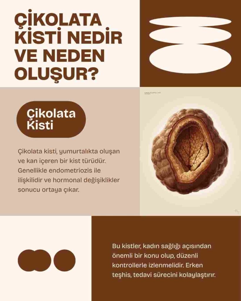 Çikolata Kisti Nedir ve neden Oluşur